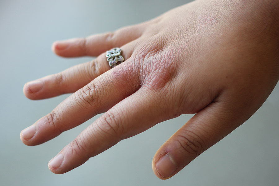 Learning to accept I have eczema has been tough for me, and like my love for rings and heels, I’ve learned to love my eczema too.